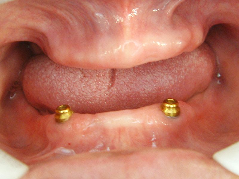 上：半口活動義齒 下：兩顆植體覆蓋式活動義齒 ft.林錫奎醫師