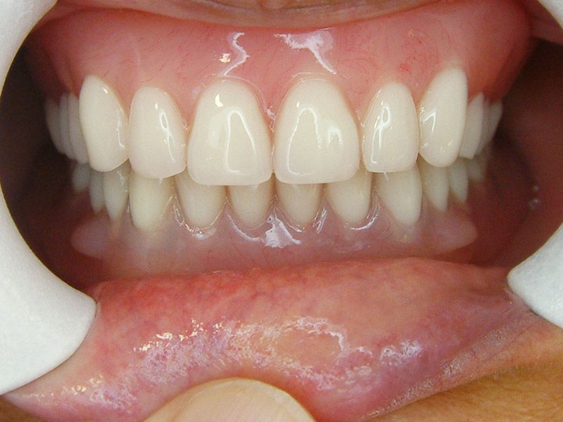 上：半口活動義齒 下：兩顆植體覆蓋式活動義齒 ft.林錫奎醫師