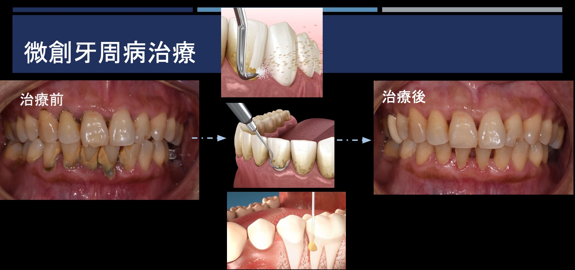 微創牙周病治療 FT.陳珮儀醫師