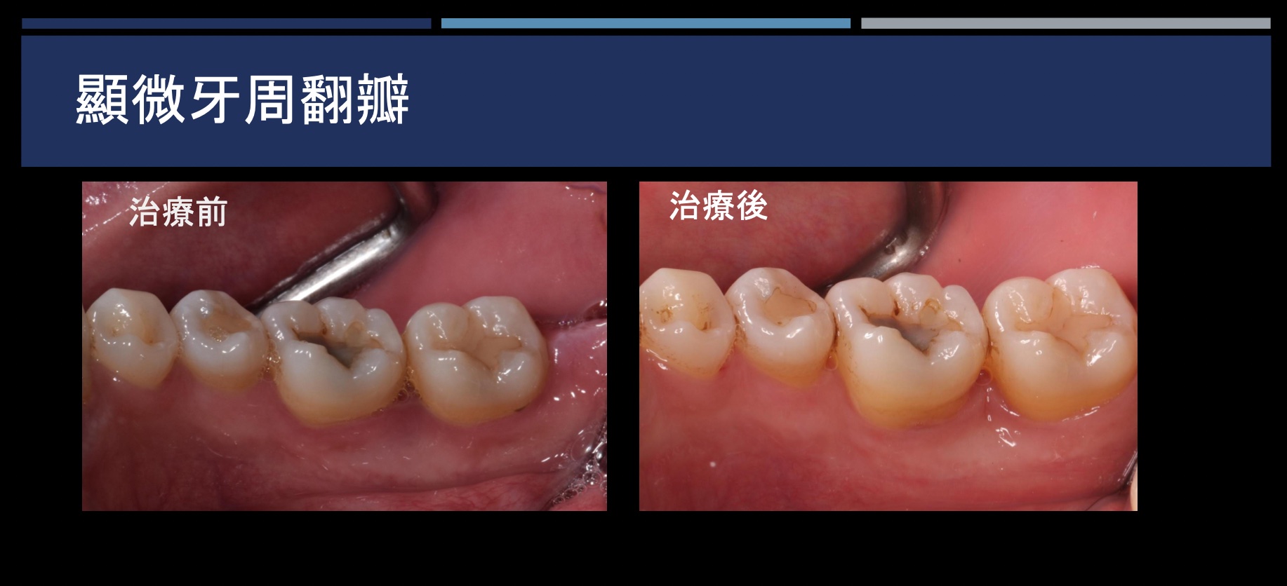 顯微牙周翻瓣 FT.陳珮儀醫師