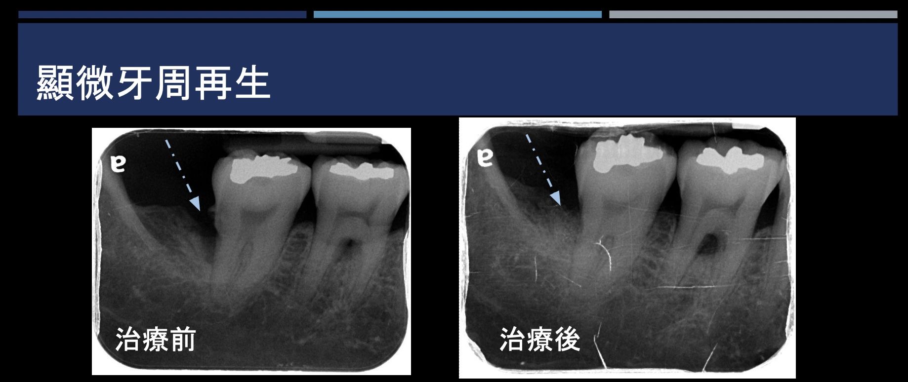 顯微牙周再生 FT.陳珮儀醫師
