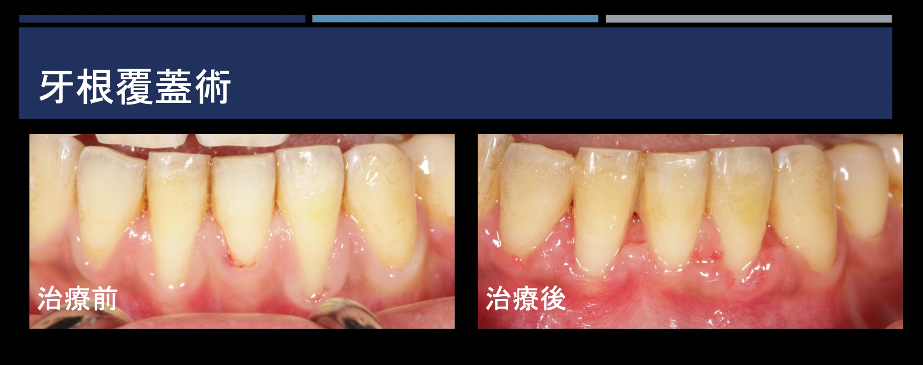 牙根覆蓋術 FT.陳珮儀醫師
